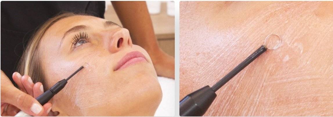 Q Therm Resurfacing